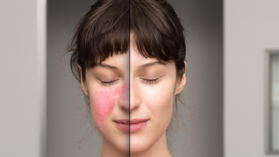 Tratează acneea rozacee: Tipuri și soluții